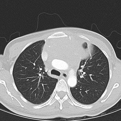 Anterior mediastinal lymphoma (Radiopaedia 29556-30061 Axial lung window 18).jpg