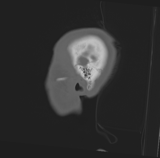 Anterior nasal spine fracture (Radiopaedia 46138-50494 Sagittal bone window 51).png