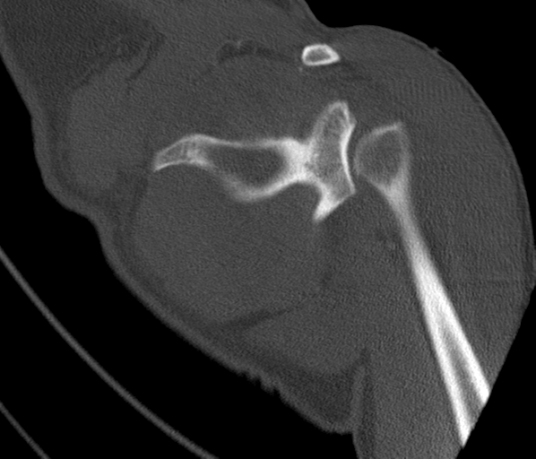 Anterior shoulder dislocation with Hill-Sachs and bony Bankart lesions (Radiopaedia 40424-42974 Coronal bone window 31).png