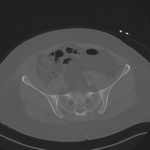 Anterior superior iliac spine avulsion fracture (Radiopaedia 44541-48244 Axial bone window 76).png