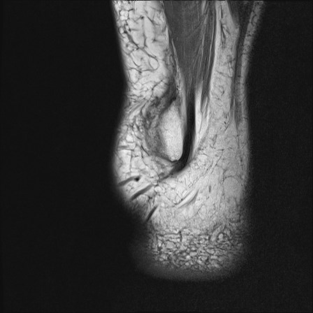 File:Anterior talofibular ligament injury - rupture with soft-tissue impingement (Radiopaedia 38765-40928 Sagittal PD 20).jpg