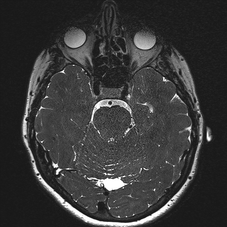 Anterior temporal encephalocele (Radiopaedia 82624-96808 Axial T2 high res 63).jpg