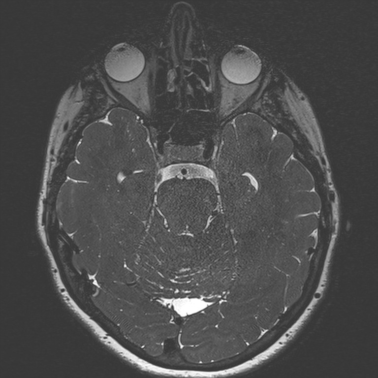 Anterior temporal encephalocele (Radiopaedia 82624-96808 Axial T2 high res 68).jpg