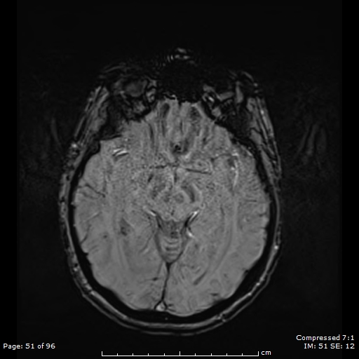 File:Anterior temporal lobe perivascular space (Radiopaedia 88283-104914 Axial SWI 20).jpg