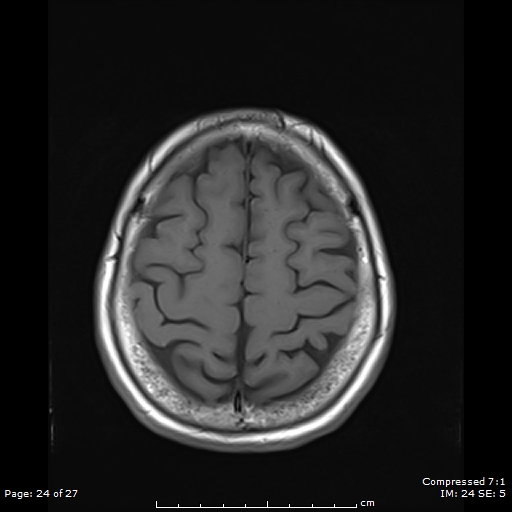 File:Anterior temporal lobe perivascular space (Radiopaedia 88283-104914 Axial T1 24).jpg