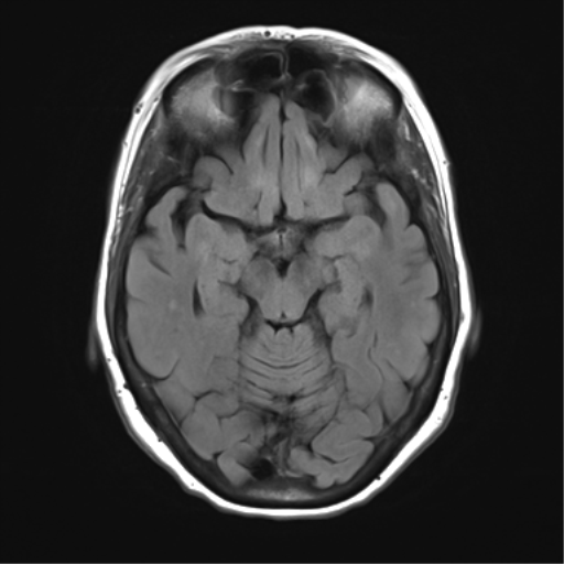 File:Anterior temporal pole cysts (Radiopaedia 46629-51102 Axial FLAIR 11).png