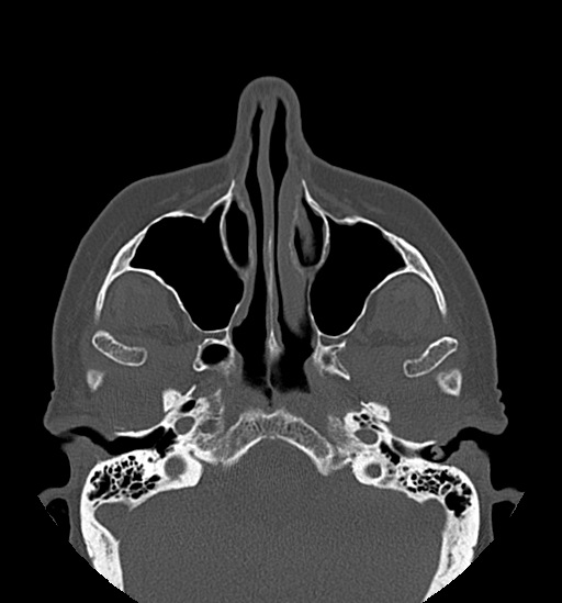 File:Anterior temporomandibular joint dislocation (Radiopaedia 59430-66784 Axial non-contrast 15).jpg