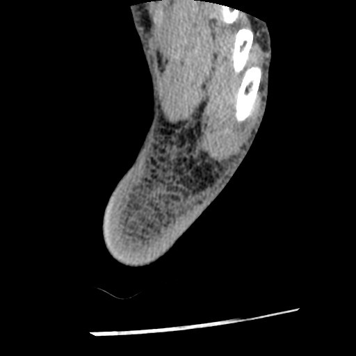 Anterior tibial artery false aneurysm (Radiopaedia 88984-105809 A 250).jpg
