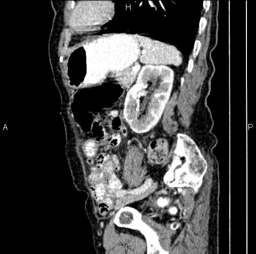 File:Aortic aneurysm and Lemmel syndrome (Radiopaedia 86499-102554 D 64).jpg