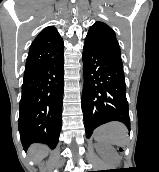 Aortic coarctation with aneurysm (Radiopaedia 74818-85828 C 89).jpg