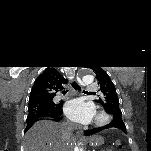 File:Aortic dissection- Stanford A (Radiopaedia 35729-37268 E 21).jpg