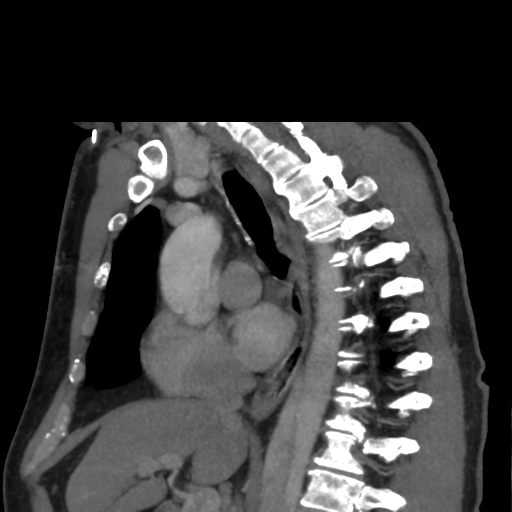 File:Aortic dissection- Stanford A (Radiopaedia 37759-39664 D 12).png