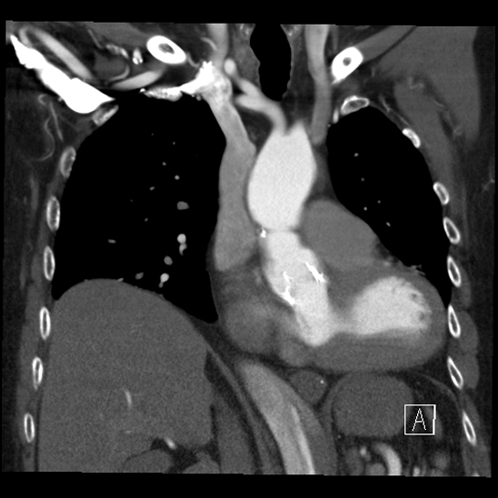 File:Aortic dissection (CTPA) (Radiopaedia 75506-86750 B 29).jpg