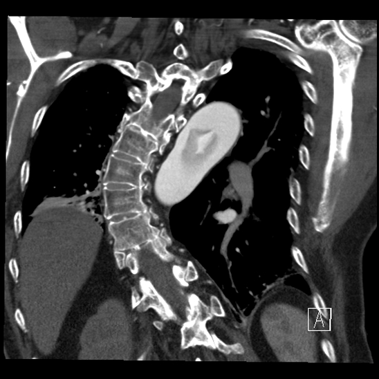 Aortic dissection (CTPA) (Radiopaedia 75506-86750 B 56).jpg