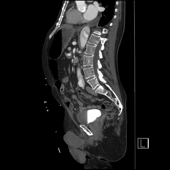 Aortic dissection (CTPA) (Radiopaedia 75506-86750 G 60).jpg