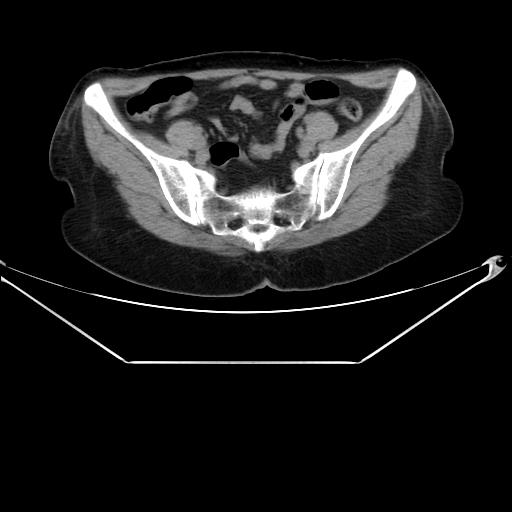 Aortic dissection (Radiopaedia 25350-25604 B 64).jpg