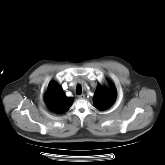 Aortic dissection (Radiopaedia 44411-48061 C 4).jpg