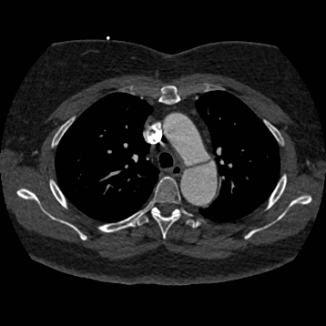 Aortic dissection (Radiopaedia 57969-64959 A 107).jpg