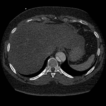 File:Aortic dissection (Radiopaedia 57969-64959 A 261).jpg