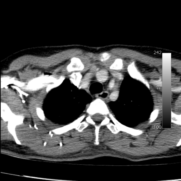 Aortic dissection - Stanford type A (Radiopaedia 29247-29659 A 14).jpg