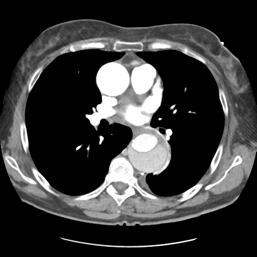 File:Aortic dissection - Stanford type B (Radiopaedia 50171-55512 A 25).png