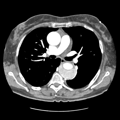 File:Aortic dissection - Stanford type B (Radiopaedia 50171-55512 C 1).png