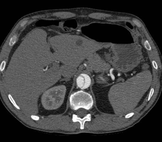 Aortic dissection - Stanford type B (Radiopaedia 73648-84437 A 118).jpg