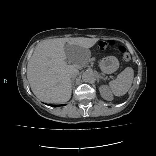 File:Aortic dissection extended to lusory artery (Radiopaedia 43686-47136 Axial non-contrast 29).jpg