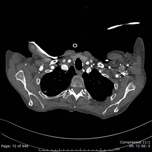 File:Aortic dissection with extension into aortic arch branches (Radiopaedia 64402-73204 B 72).jpg