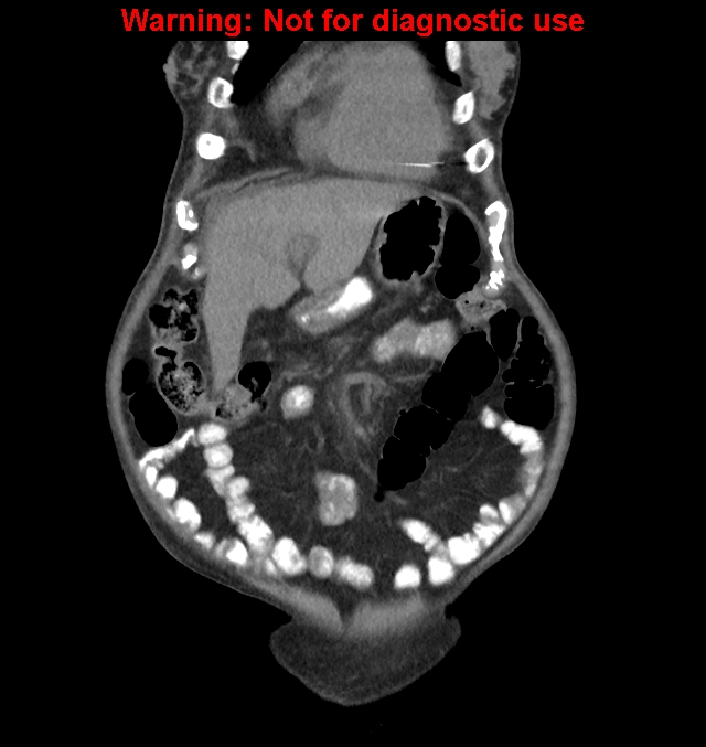 Aortic graft infection (Radiopaedia 44979-48907 non-contrast 11).jpg