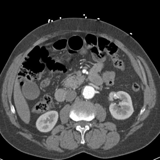 Aortic intramural hematoma (Radiopaedia 31139-31838 B 103).jpg