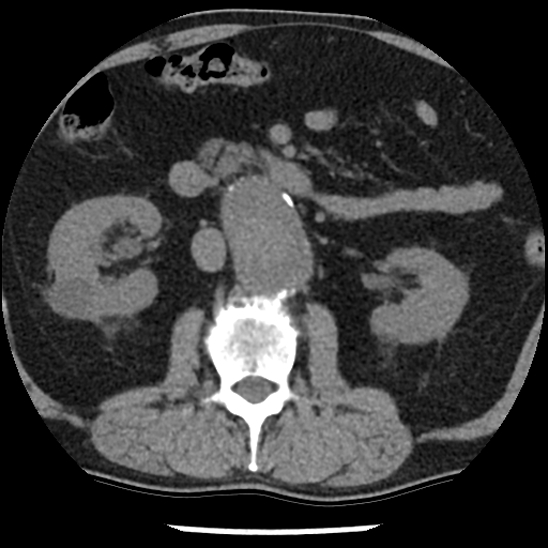 File:Aortic intramural hematoma (type B) (Radiopaedia 79323-92387 Axial non-contrast 69).jpg