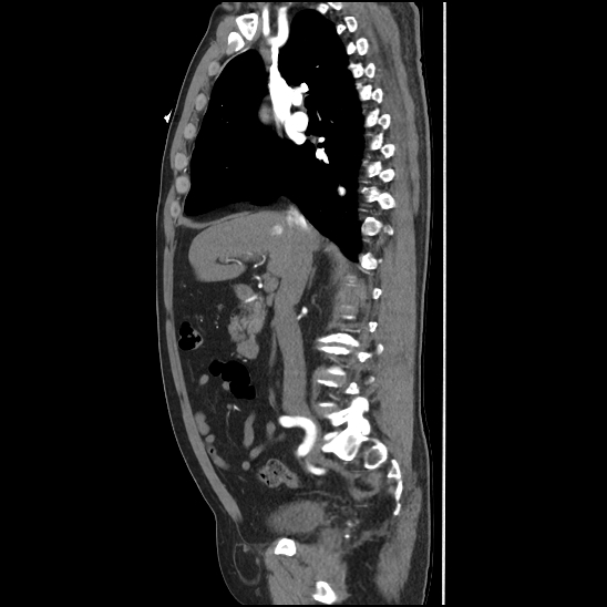 Aortic intramural hematoma (type B) (Radiopaedia 79323-92387 H 19).jpg