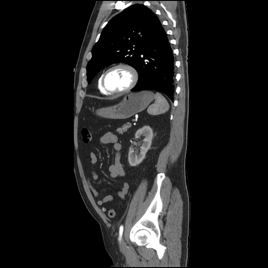 Aortic intramural hematoma (type B) (Radiopaedia 79323-92387 H 40).jpg