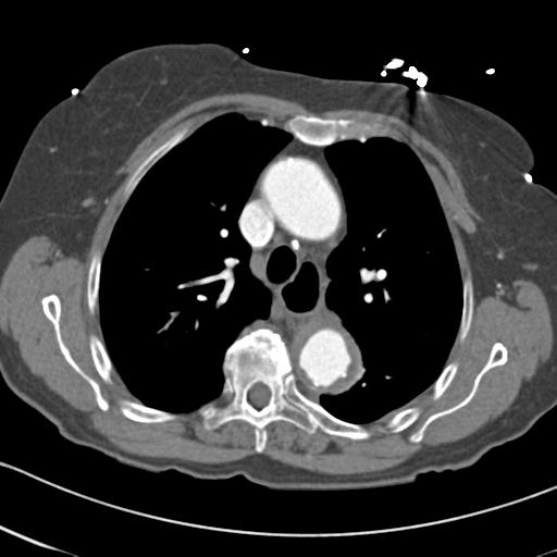 Aortic intramural hematoma from penetrating atherosclerotic ulcer (Radiopaedia 31137-31836 A 27).jpg