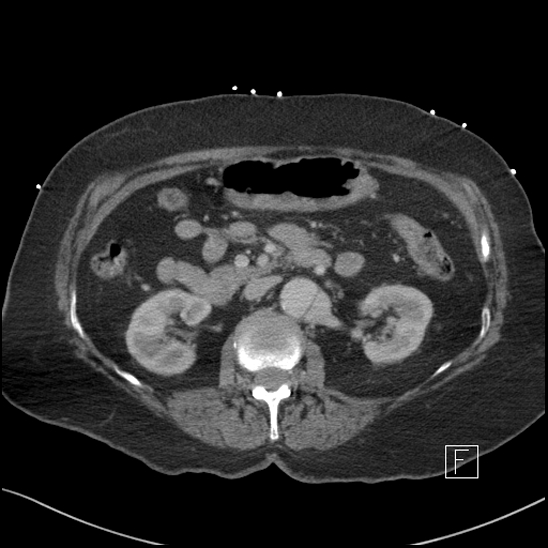 File:Aortic intramural hematoma with dissection and intramural blood pool (Radiopaedia 77373-89491 E 29).jpg