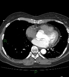 Aortic valve endocarditis (Radiopaedia 87209-103485 C 60).jpg