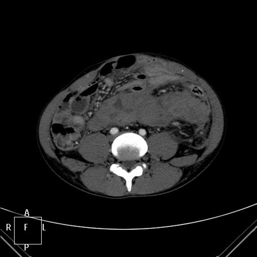 File:Aorto-left renal vein fistula (Radiopaedia 45534-49628 A 47).jpg