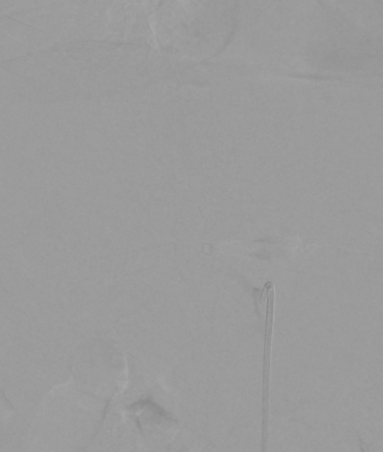 Aorto portal shunt (Radiopaedia 69573-79586 Frontal Celiac axis 4).jpg