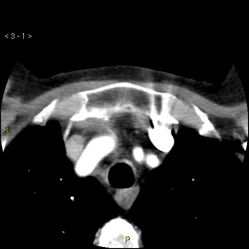 Aortoiliac occlusive disease (Radiopaedia 16828-16548 A 1).jpg