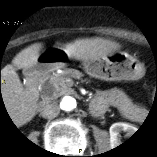 Aortoiliac occlusive disease (Radiopaedia 16828-16548 A 57).jpg