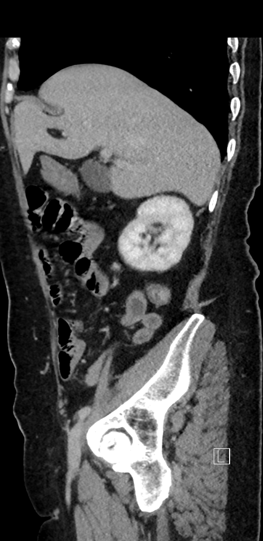 Appendiceal hemorrhage (Radiopaedia 70830-81025 Sagittal C+ delayed 35).jpg