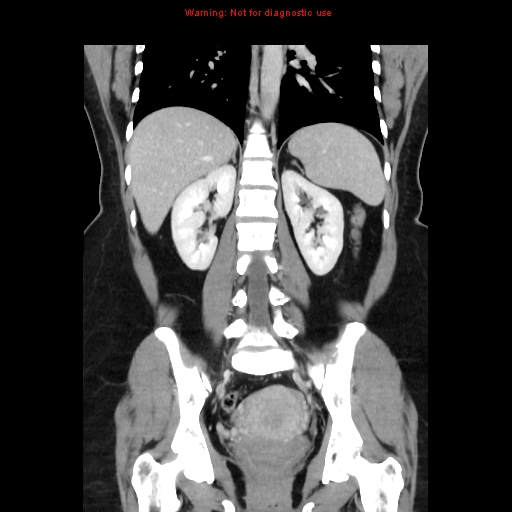 File:Appendiceal mucinous cystadenoma (Radiopaedia 8263-9111 B 49).jpg
