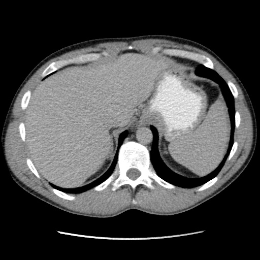 File:Appendicitis complicated by post-operative collection (Radiopaedia 35595-37113 A 10).jpg