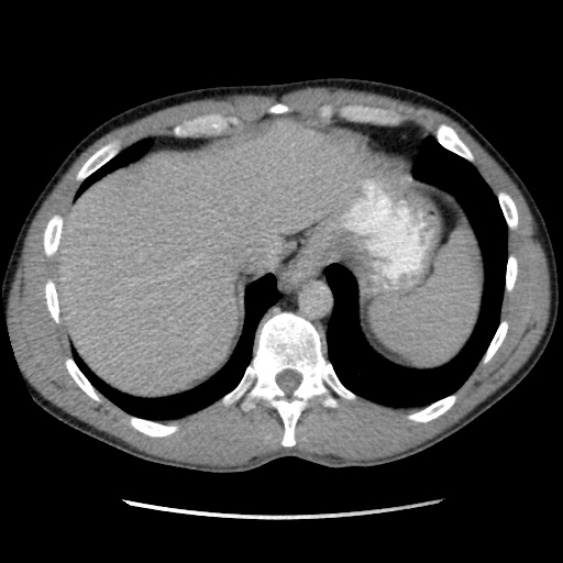 Appendicitis complicated by post-operative collection (Radiopaedia 35595-37113 A 8).jpg