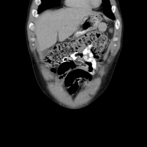 File:Appendicitis complicated by post-operative collection (Radiopaedia 35595-37113 B 13).jpg