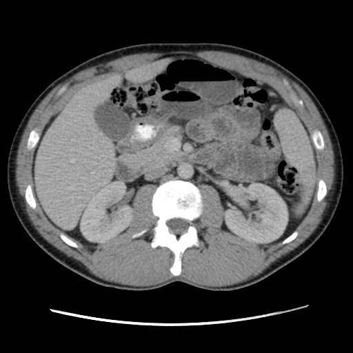 File:Appendicitis complicated by post-operative collection (Radiopaedia 35595-37114 A 33).jpg