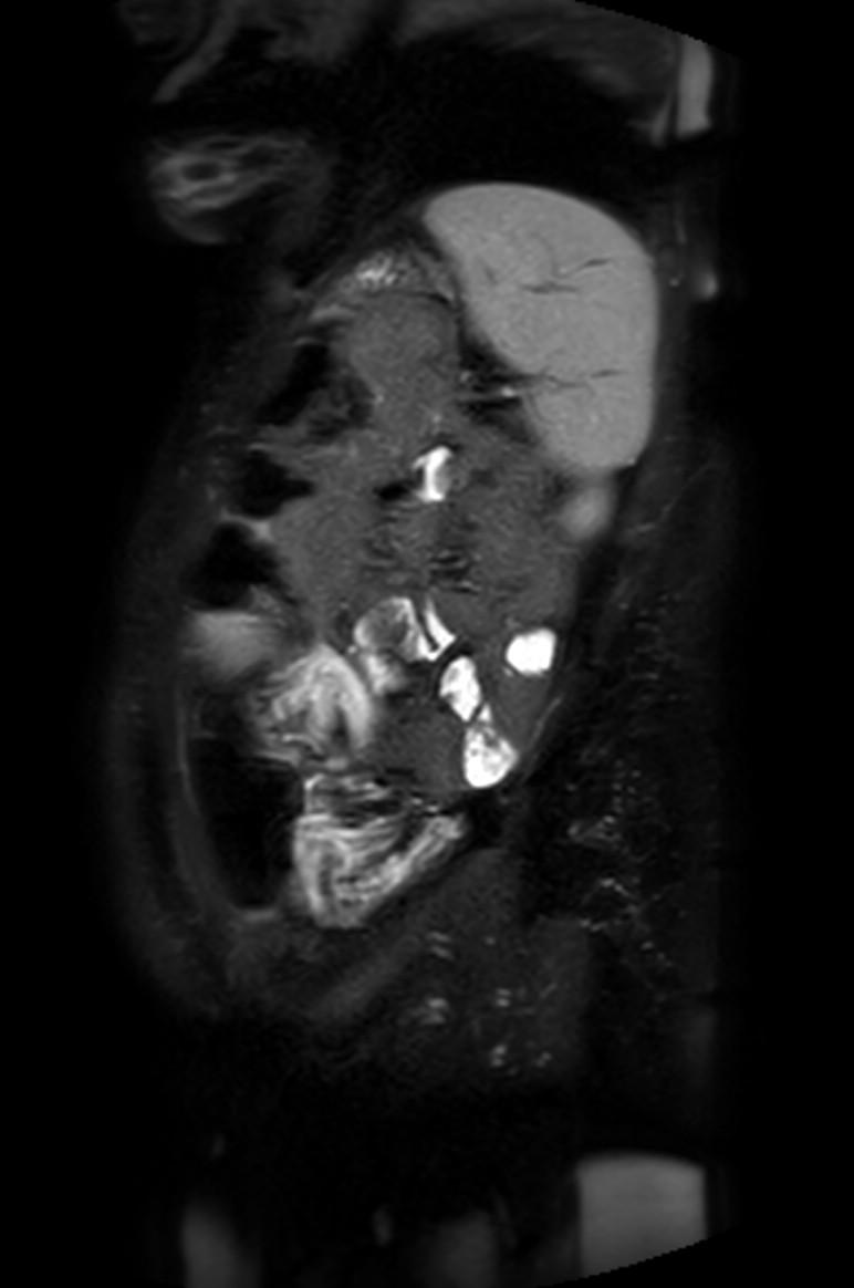 Appendicitis in gravida (MRI) (Radiopaedia 89433-106395 Sagittal T2 SPAIR 12).jpg