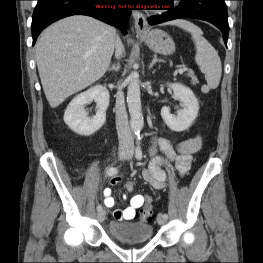 File:Appendicitis mass in inguinal hernia (Radiopaedia 26858-27029 B 39).jpg
