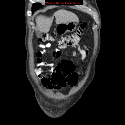 File:Appendicitis mass in inguinal hernia (Radiopaedia 26858-27029 B 7).jpg